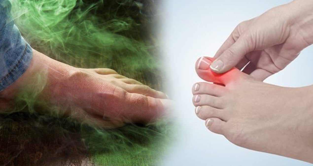 ayak mantarinin kokunu kurutuyor 2 malzeme yetiyor kokudan eser kalmiyor UNPqEpOw